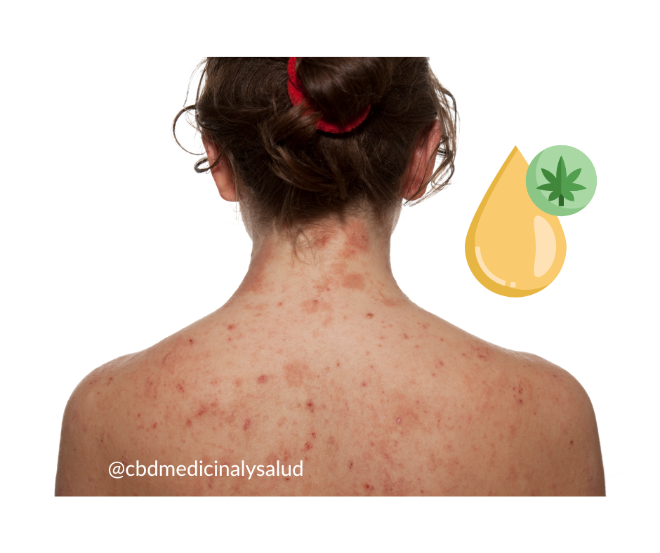 CBD y la piel