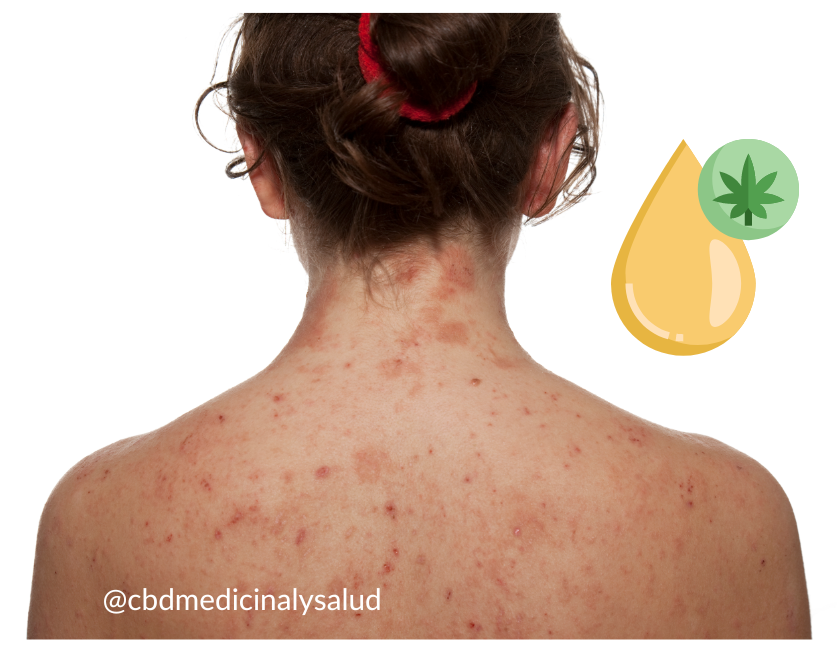 CBD espalda dermatitis